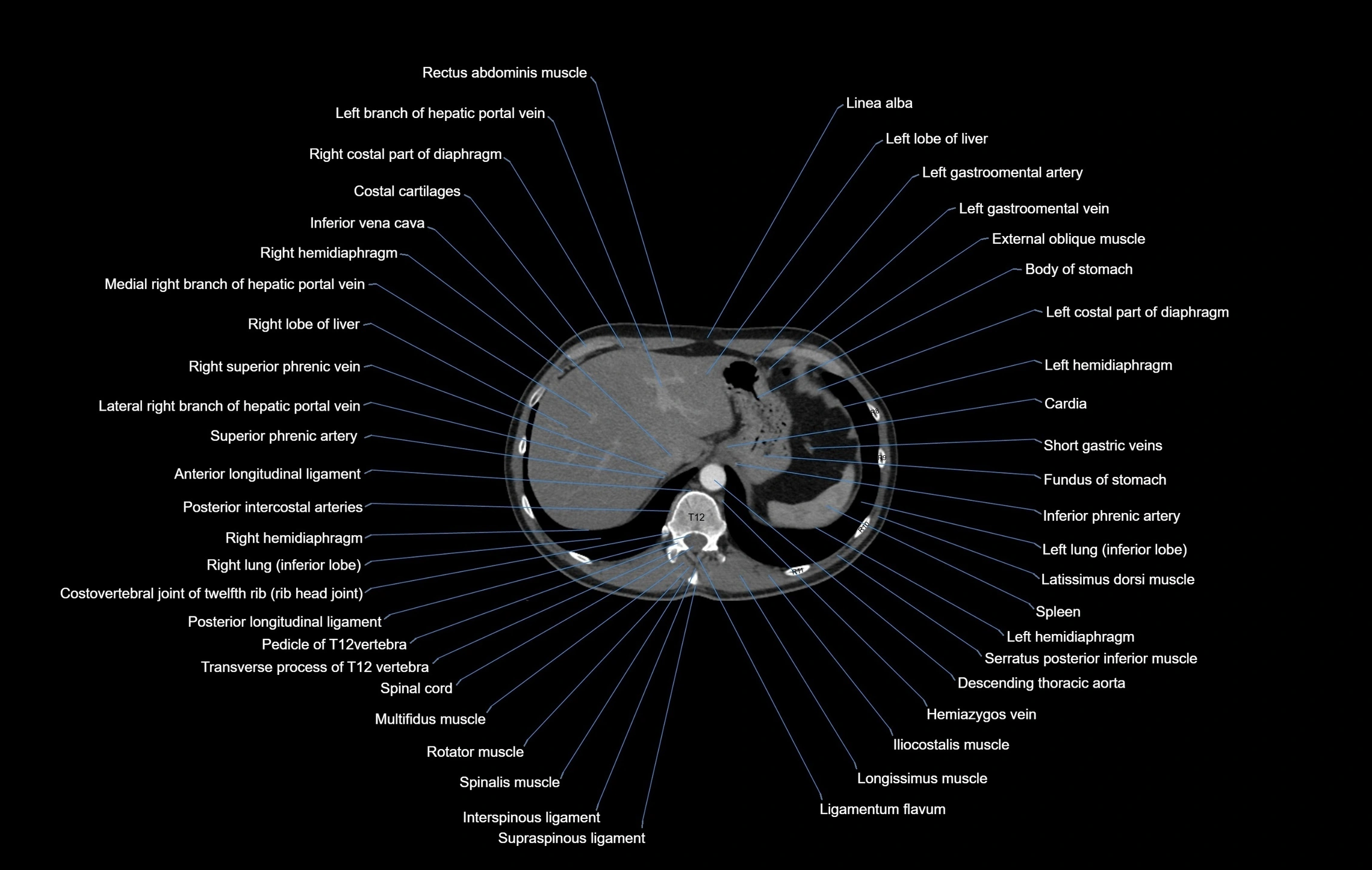 CT chest (thorax) soft tissue window labelled axial cross sectional anatomy radiology image-00110.webp
